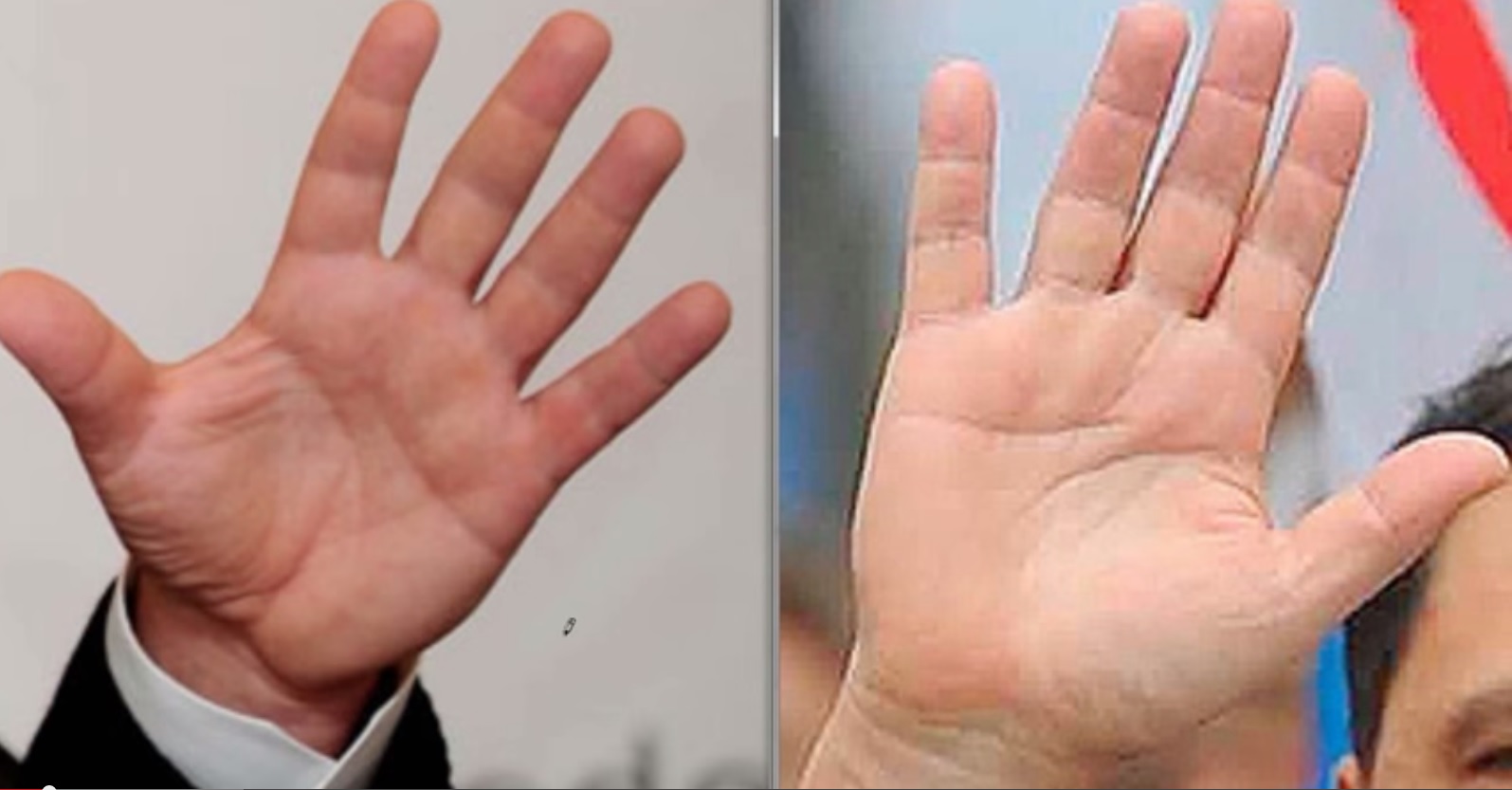 Ձեր ձեռքի ափերից կարող եք  հասկանալ՝ շաքարախտ ունե՞ք, թե ոչ